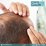 Best Hair Transplant Cost in Chennai | DHI India