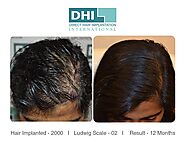 Best Hair Transplant in Chennai-DHI Chennai