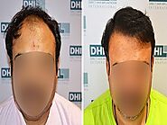 Affordable Hair Transplant in Jaipur - DHI India