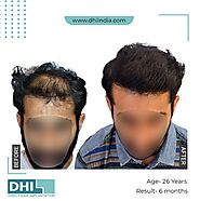 Get The Finest Hair Transplant Surgeon In Jaipur-DHI