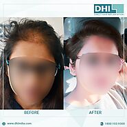 Top Surgeons For Hair Transplant In Lucknow-DHI India