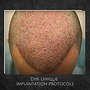 What to expect from the best hair transplant clinic in Lucknow?
