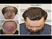 DHI-A Popular Place For Hair Transplant in Jaipur