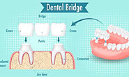 Smile Enhancement: How Esthetic Dentistry and Endodontics Facilitate Front Teeth Dental Bridge Placement