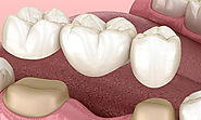 How Porcelain Bridge And Lumineers Can Fix Your Smile?
