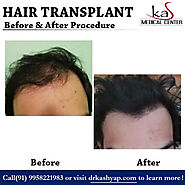 Best Hair Transplant Clinic in New Delhi - EMI AVAILABLE
