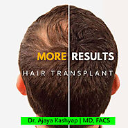 Best Hair Transplant and Hair Loss Treatment in Delhi India by Expert Surgeon