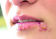 Treatment for Cold Sores - Philadelphia Acupuncture Clinic - Dr. Tsan & Co