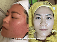 Best Extraction Facial In Singapore