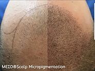 Scalp Micro Pigmentation For Hair Growth