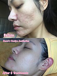 Get A Flawless Skin With Advanced Acne Scars Treatment