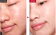 Hydra Facial For Glowing Skin And Get Rid Of Anti-Aging