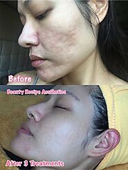 Pick The Right Acne Scar Treatment In Singapore