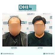 DHI- Global Leader in Hair Restoration