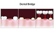 Dental Bridges Are a Solution for Missing Teeth