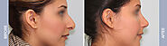 Best Rhinoplasty Surgeon in Chandigarh