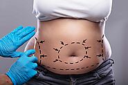 Tummy Tuck Surgery – All You Need to Know