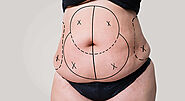 Difference Between Full & Mini Tummy Tuck Surgery