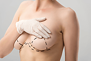 Everything You Need to Know Before Getting a Breast Lift