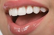 Get Tooth Whitening Treatment at Epping Dental Clinic