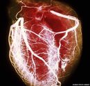 Doctors store 1,600 hearts for study