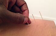 Get Most Effective Acupuncture Treatment in Bromley