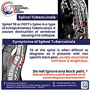 Are you suffering from Spinal Tuberculosis? - CESS - Center of excellence in spine surge, Spine Surgeon in Mumbai