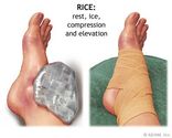 When your bunion is irritated and causing pain, you can try the "RICE" method.
