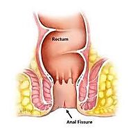 A Comprehensive Guide To Anal Fissure: Symptoms, Causes & Treatment