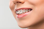 7 Tips to Find the Right Orthodontic Treatment for You - Beauty Around The Corner