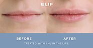 Lip Fillers, Lip Injections & Lip Plumper Jacksonville