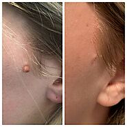 Mole Removal & Mole Removal on Face Jacksonville