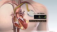 Cardiac Resynchronization Therapy For Heart Failure