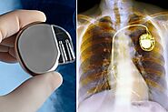 Signs You May Need a Pacemaker By Best Cardiologist Doctor in Delhi