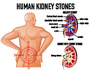 Kidney Stones Treatment - Philadelphia Holistic Clinic - Dr. Tsan & Assoc.