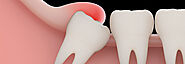 Best Wisdom Tooth Extraction Treatment | Wisdom Teeth Removal Cost In India