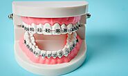 5 Benefits of Dental Braces | Maroubra Dental Avenue