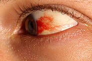 Traumatic Subconjunctival Hemorrhage|Causes, Symptoms And Treatment