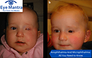 Anophthalmia And Microphthalmia: Symptoms And Treatment