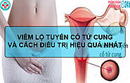 VIÊM LỘ TUYẾN CỔ TỬ CUNG VÀ CÁCH ĐIỀU TRỊ HIỆU QUẢ NHẤT!