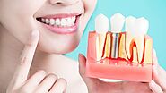 Best Affordable Palmdale Dentist In CA |AV Dental