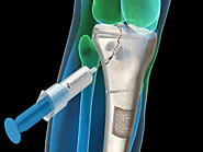Global Bone Void Fillers Market Size, Share, Trend & Forecast 2026 | TechSci Research