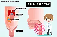 Oral Cancer Treatment in Jaipur by Dr.Tara Chand | Medical Oncologist