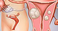 A Visual Guide to Uterine Fibroids