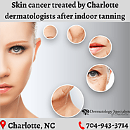 Skin cancer is treated by top Charlotte dermatologists after indoor tanning