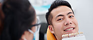 Everything You Need to Know About Dental Veneers