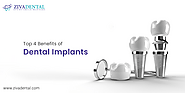 What are the Benefits of Dental Implants?