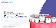 Instances Why You Should Opt for Dental Crowns