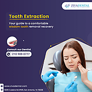 Tooth Extraction in San Antonio