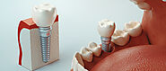 A Complete Guide to Understanding Dental Implants
